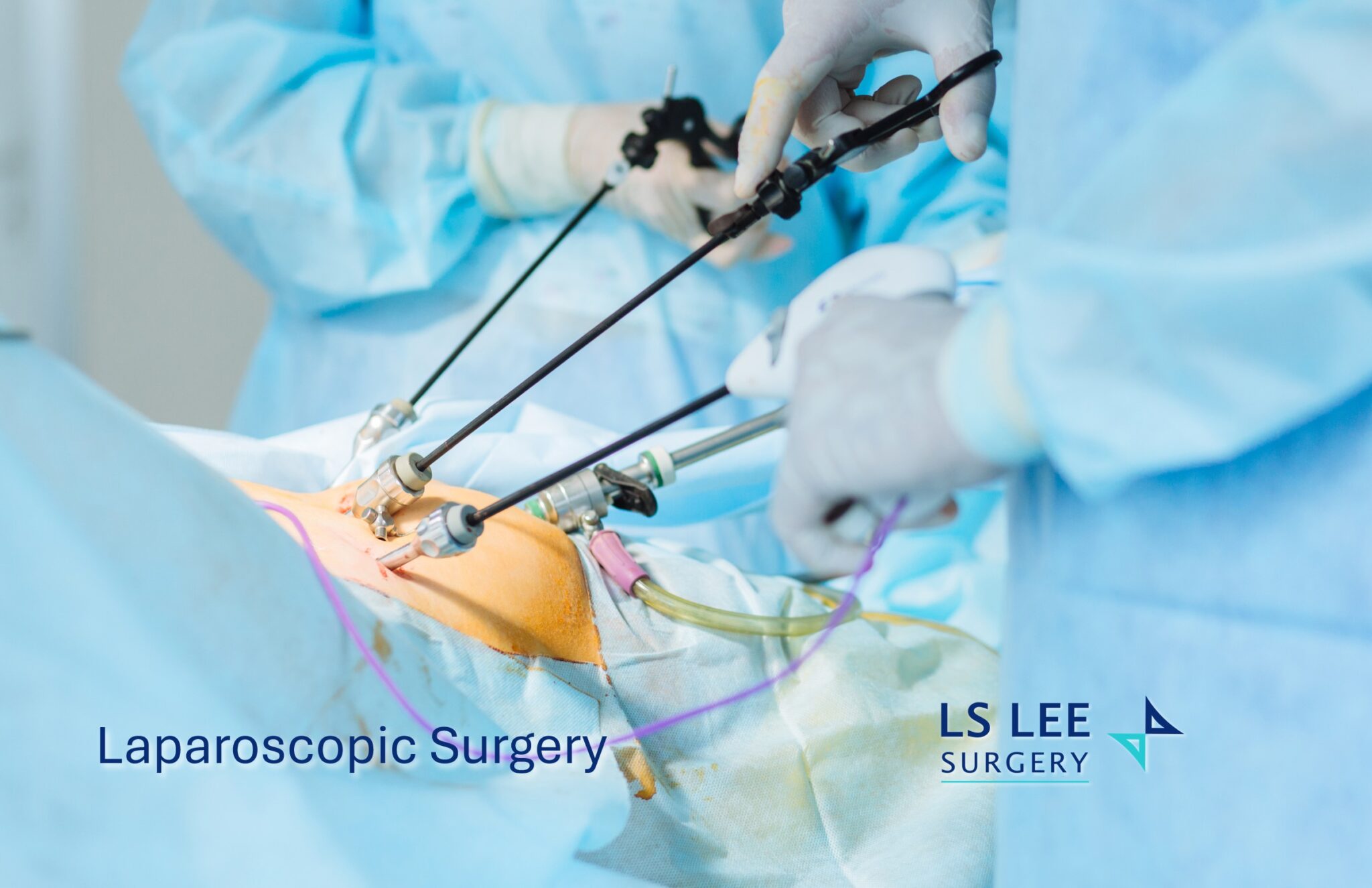 Laparoscopic Cholecystectomy Singapore Keyhole Gallbladder Surgery