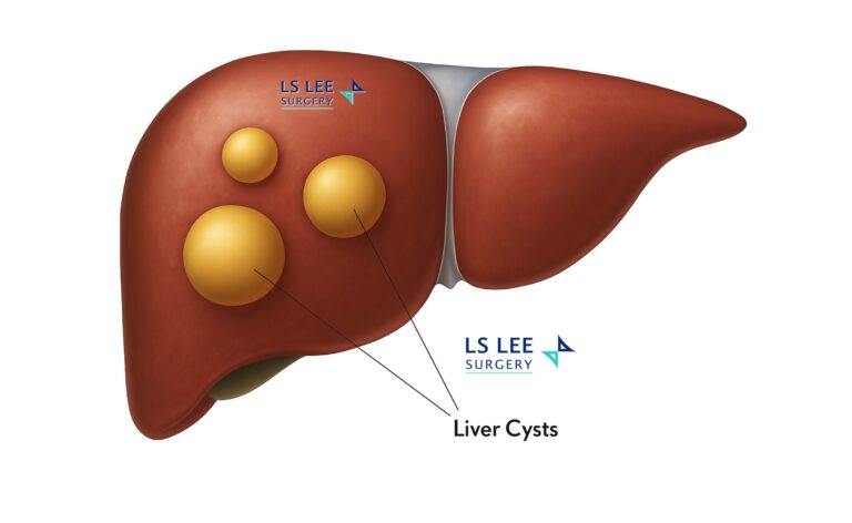 Liver Cyst