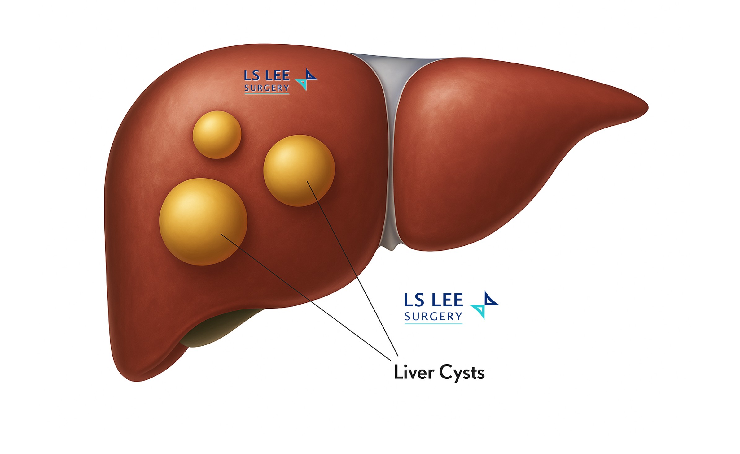 Liver Cyst