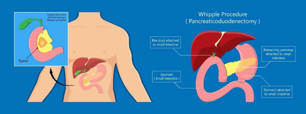 Pancreas Surgery In Singapore Ls Lee Surgery Clinic