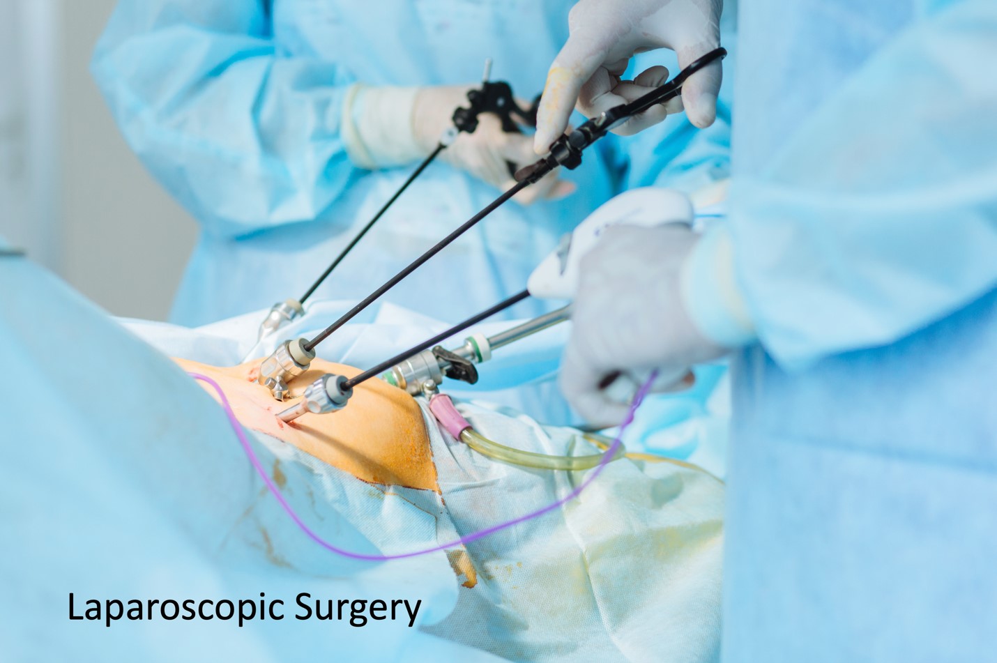 Laparoscopic Cholecystectomy (Keyhole Surgery)