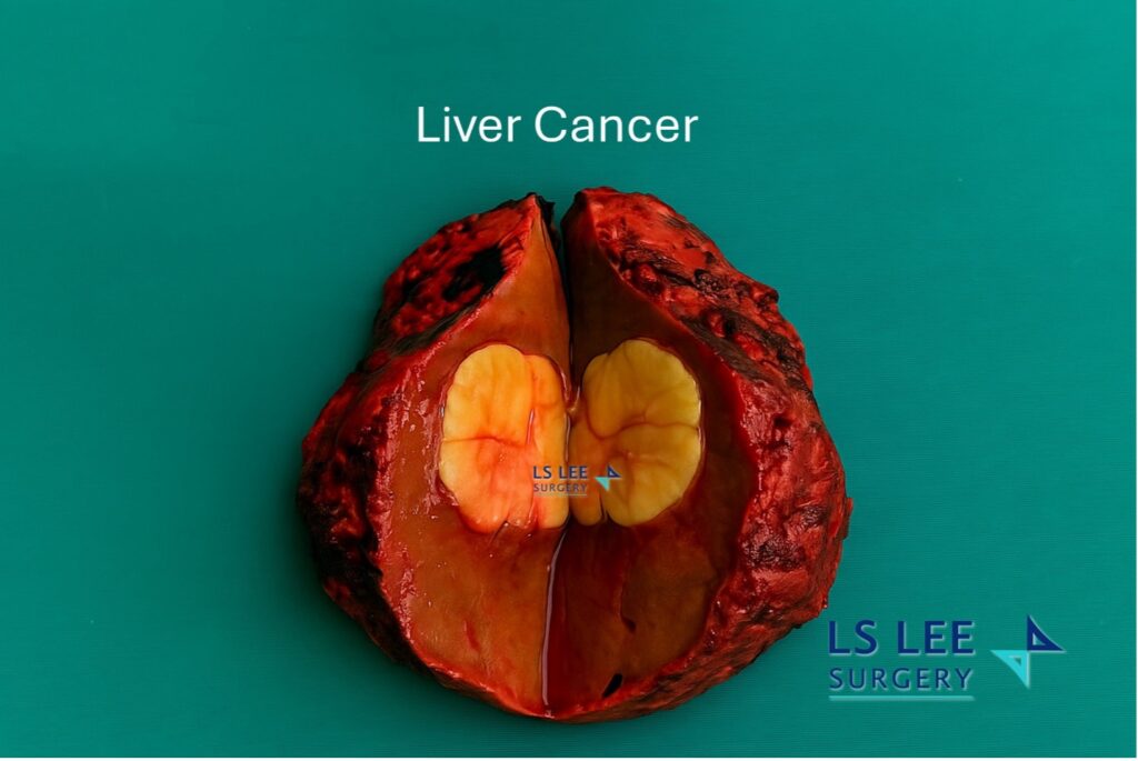 Liver Cancer
