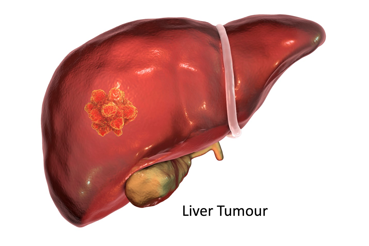 liver tumour