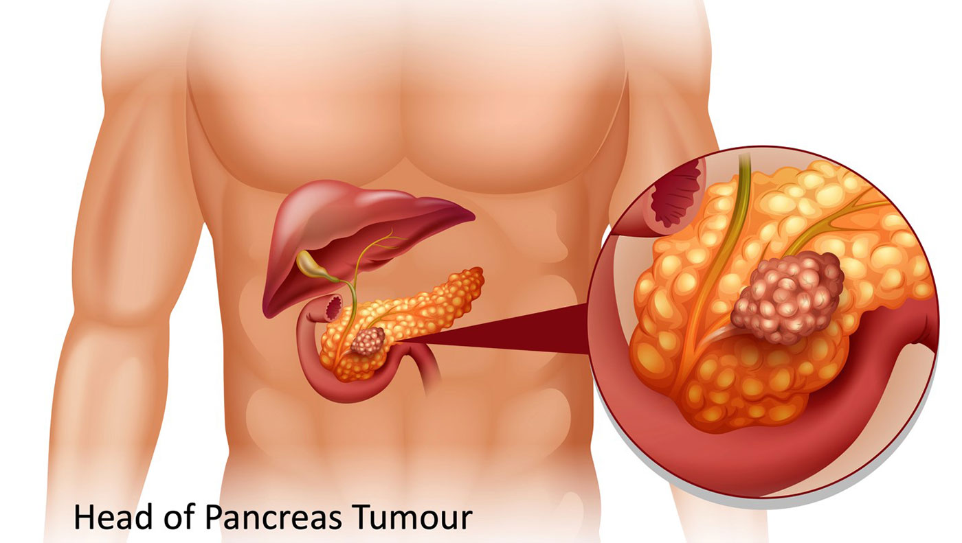 Minimally Invasive Pancreatectomy