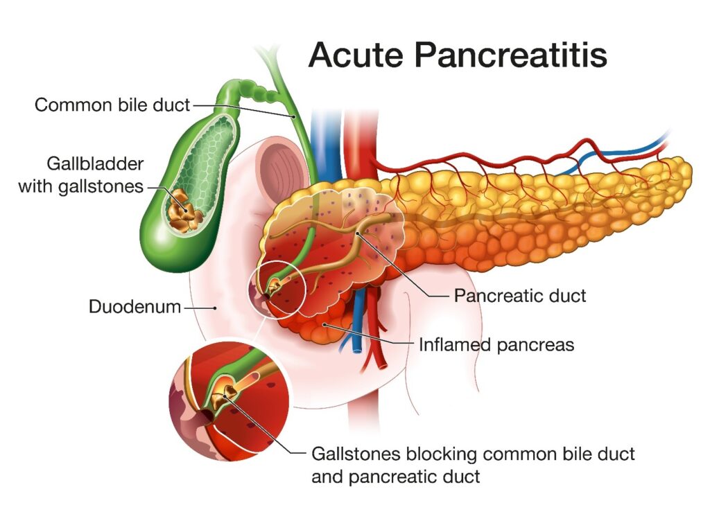 Gallstone pancreatitis:
