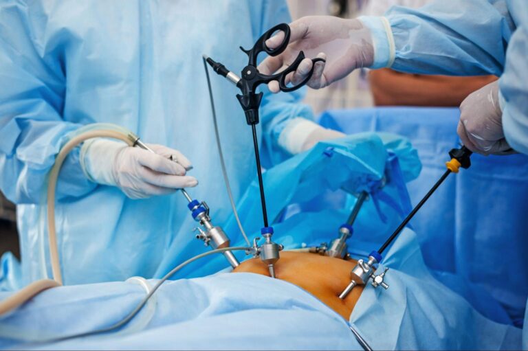 Laparoscopic Cholecystectomy (Keyhole Surgery)