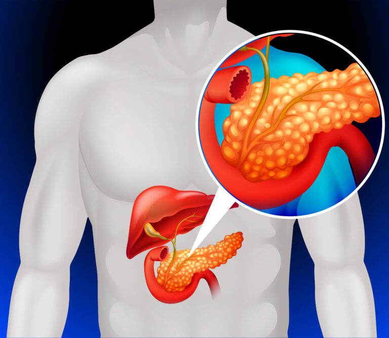What Are Pancreatic Neuroendocrine Tumours and How Are They Treated