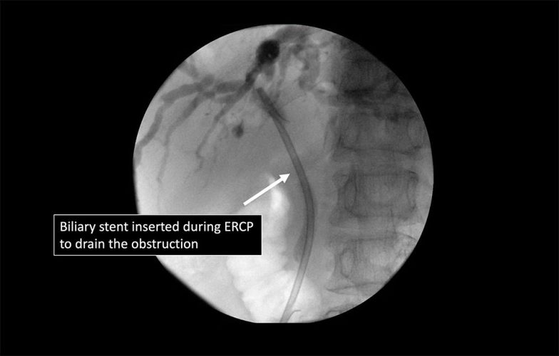 Bile-Duct2