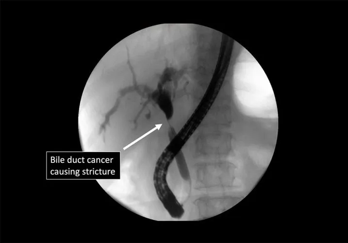 Bile-Duct3