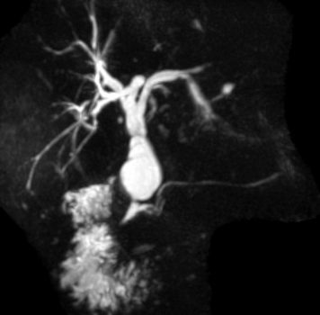 Choledochal cyst