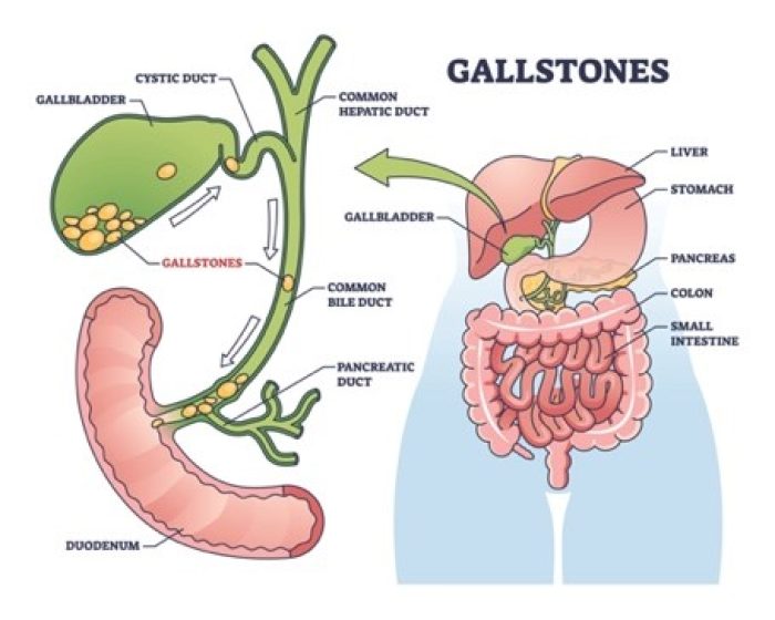 Possible Complications of Gallstones