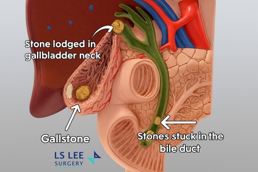 Gallstone multiple locations Dr Lee Lip Seng