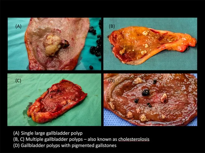 Gallstone2