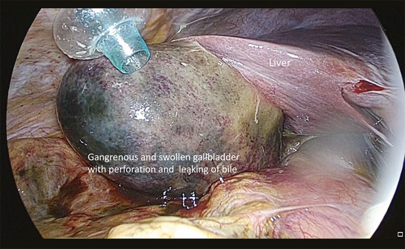 Gallstone3