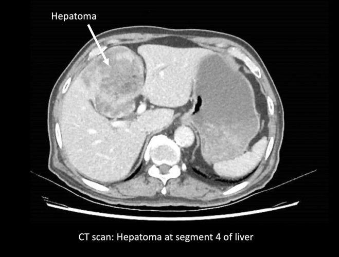 Liver-Cancer-2